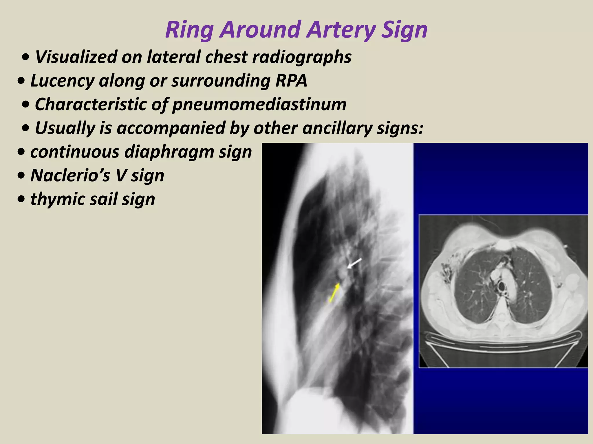 Ring Around Artery Sign
• Visualized on lateral chest radiographs
• Lucency along or surrounding RPA
• Characteristic of pneumomediastinum
• Usually is accompanied by other ancillary signs:
• continuous diaphragm sign
• Naclerio’s V sign
• thymic sail sign
 