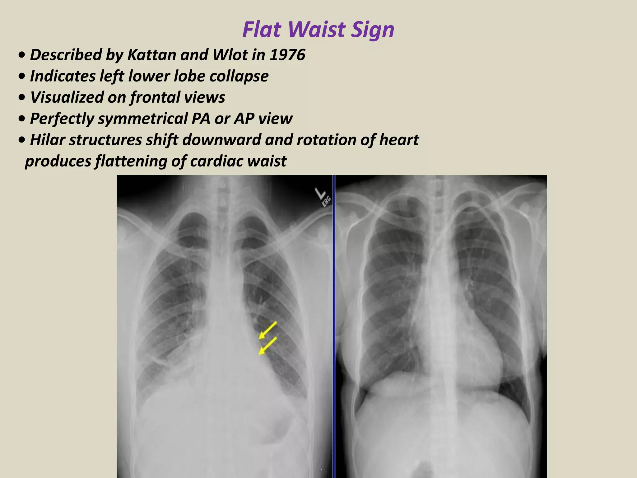 Flat Waist Sign
• Described by Kattan and Wlot in 1976
• Indicates left lower lobe collapse
• Visualized on frontal views
• Perfectly symmetrical PA or AP view
• Hilar structures shift downward and rotation of heart
produces flattening of cardiac waist
 