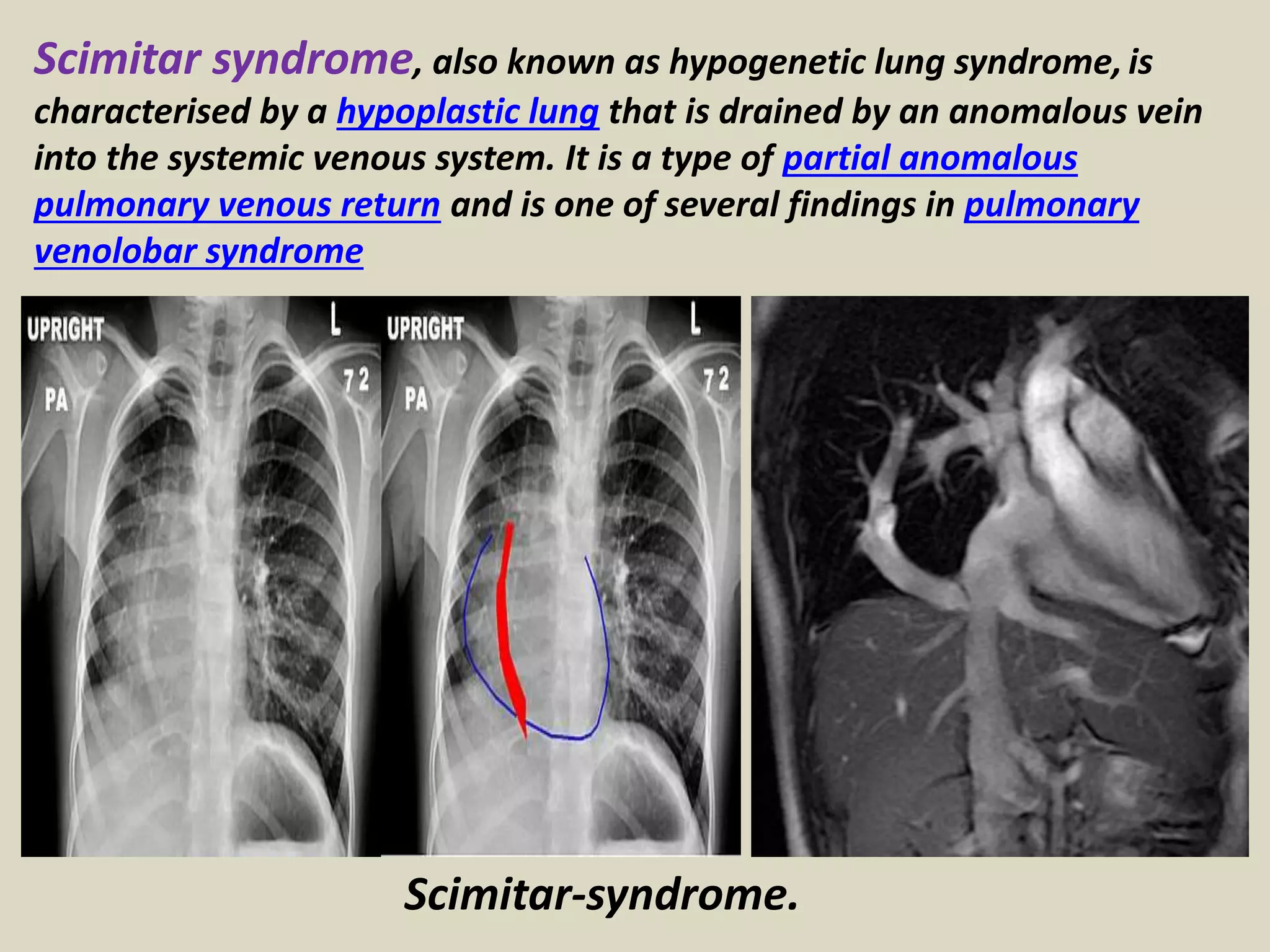 Scimitar syndrome, also known as hypogenetic lung syndrome, is
characterised by a hypoplastic lung that is drained by an anomalous vein
into the systemic venous system. It is a type of partial anomalous
pulmonary venous return and is one of several findings in pulmonary
venolobar syndrome
Scimitar-syndrome.
 
