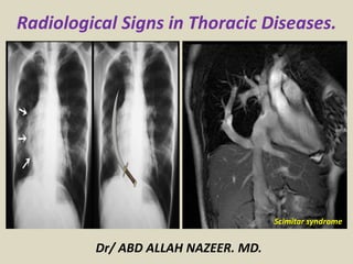 Radiological Signs in Thoracic Diseases.
Dr/ ABD ALLAH NAZEER. MD.
Scimitar syndrome
 