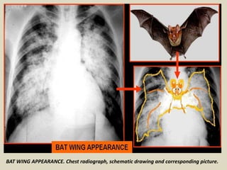Wing Radiographs Presentation1.pptx, radiological signs in thoracic radiology. | PPTX