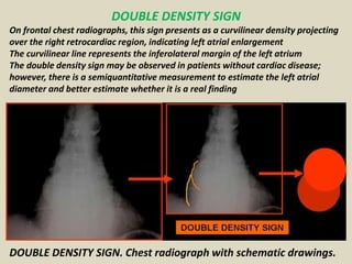 Sign For Density Presentation1.pptx, radiological signs in thoracic radiology. | PPTX