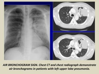 Presentation1.pptx, radiological signs in thoracic radiology. | PPTX