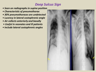 Presentation1.pptx, radiological signs in thoracic radiology. | PPTX