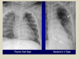 Triangular Sign Chest Presentation1.pptx, radiological signs in thoracic radiology. | PPTX