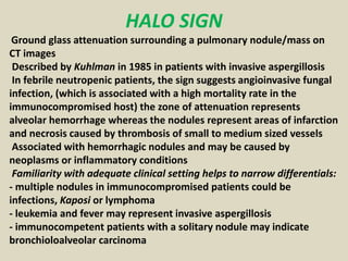 HALO SIGN
Ground glass attenuation surrounding a pulmonary nodule/mass on
CT images
Described by Kuhlman in 1985 in patien...