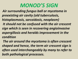 MONOD’S SIGN
Air surrounding fungus ball or mycetoma in
preexisting air cavity (old tuberculosis,
histoplasmosis, sarcoido...