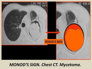 MONOD’S SIGN. Chest CT. Mycetoma.
 