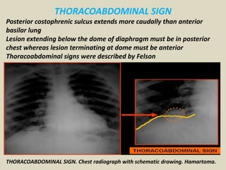 THORACOABDOMINAL SIGN
Posterior costophrenic sulcus extends more caudally than anterior
basilar lung
Lesion extending belo...