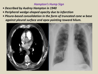 Hampton’s Hump Sign
• Described by Audrey Hampton in 1940
• Peripheral wedge-shaped opacity due to infarction
• Pleura-bas...