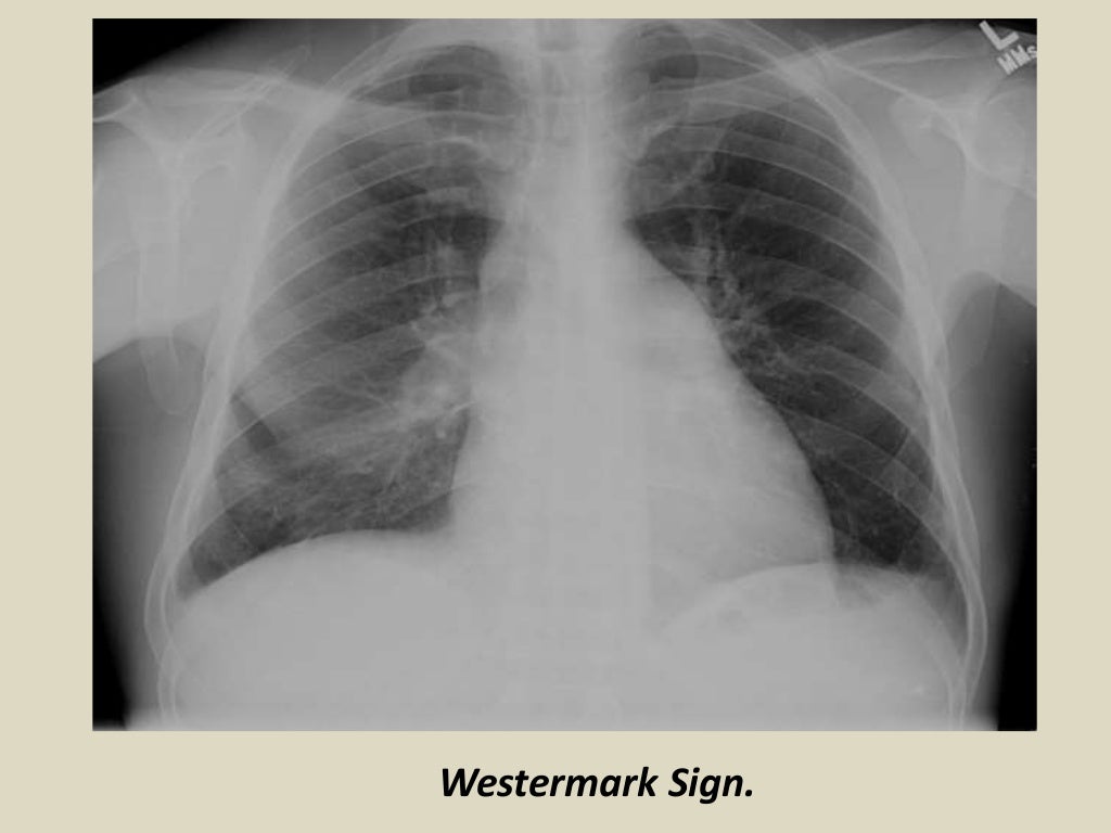 Presentation1.pptx, radiological signs in thoracic radiology.