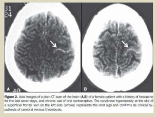 String. Sign Radiology Brain Presentation1.pptx, radiological classical signs and appearances in ...
