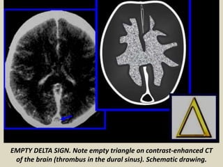 Presentation1.pptx, radiological classical signs and appearances in ...