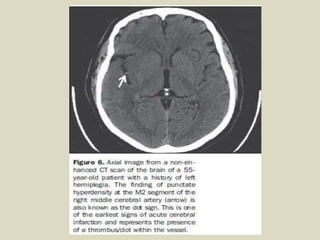 String. Sign Radiology Brain Presentation1.pptx, radiological classical signs and appearances in ...