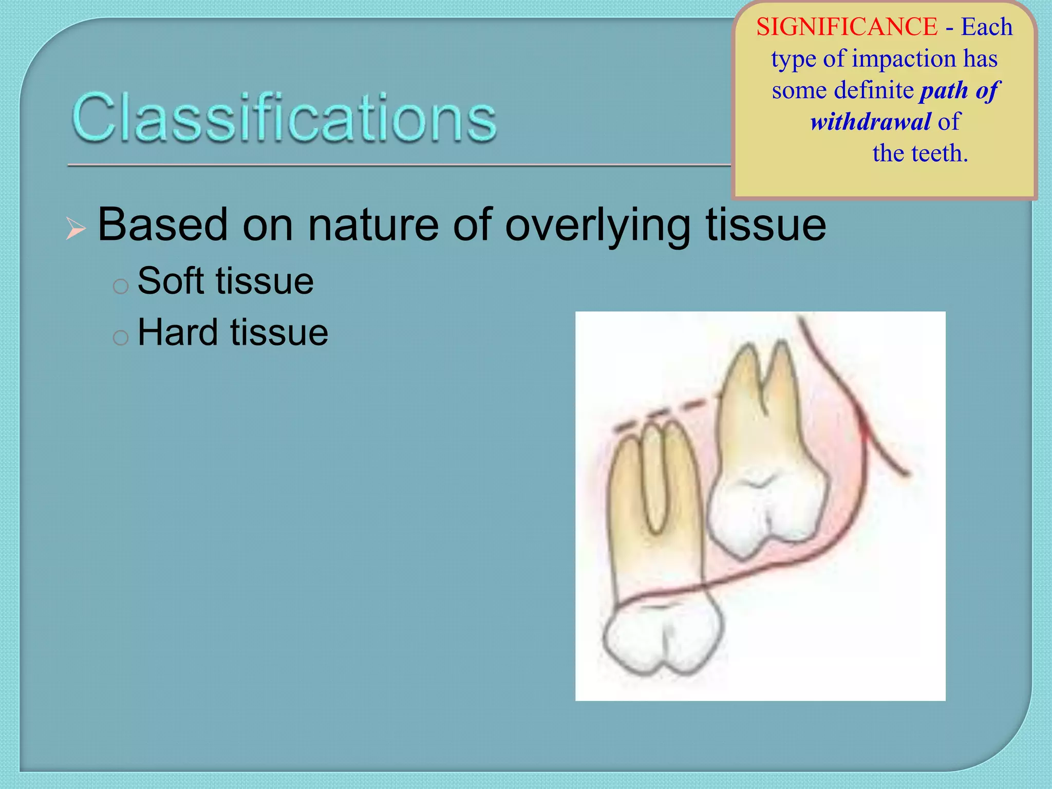  Based on nature of overlying tissue
o Soft tissue
o Hard tissue
SIGNIFICANCE - Each
type of impaction has
some definite path of
withdrawal of
the teeth.
 