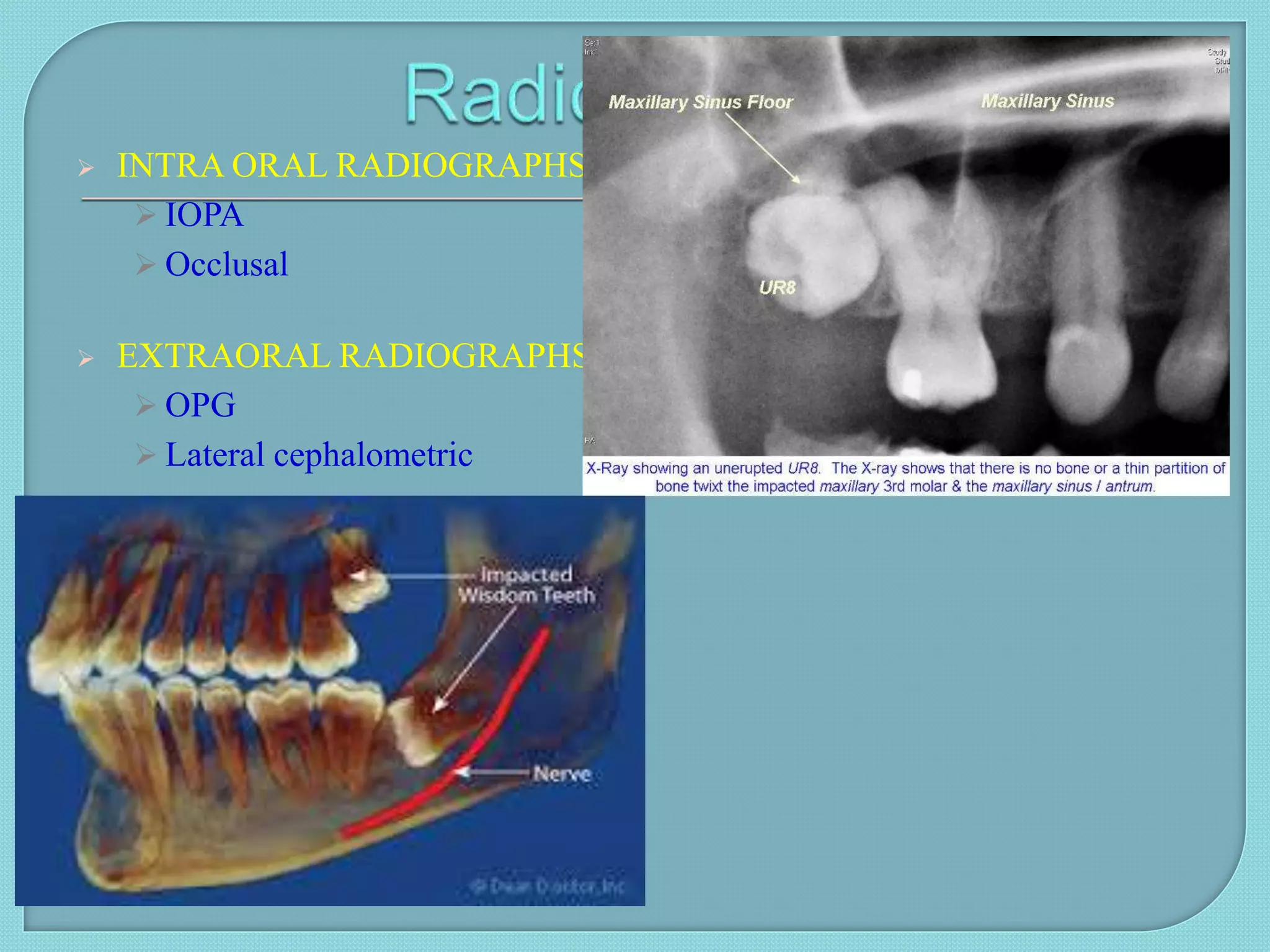  INTRA ORAL RADIOGRAPHS
 IOPA
 Occlusal
 EXTRAORAL RADIOGRAPHS
 OPG
 Lateral cephalometric
 DIGITAL IMAGING
 CT
 CBCT
 LOCALIZATION TECHNIQUES:
 -Buccal object rule (SLOB)
 -CBCT(3D)
 