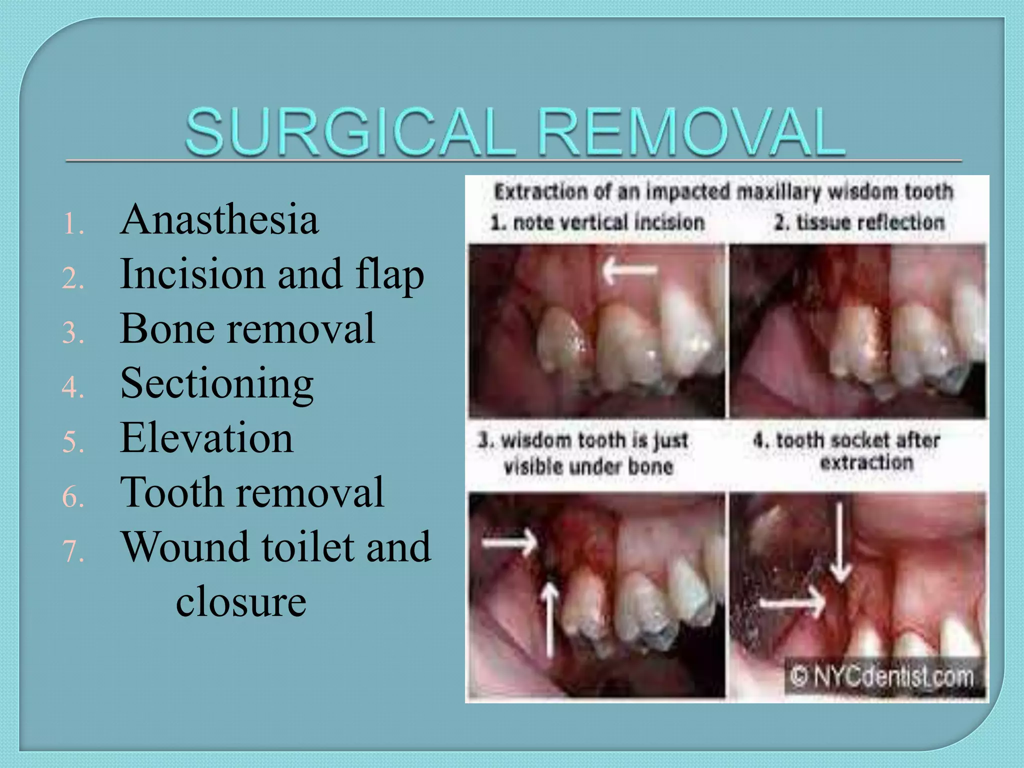 1. Anasthesia
2. Incision and flap
3. Bone removal
4. Sectioning
5. Elevation
6. Tooth removal
7. Wound toilet and
closure
 