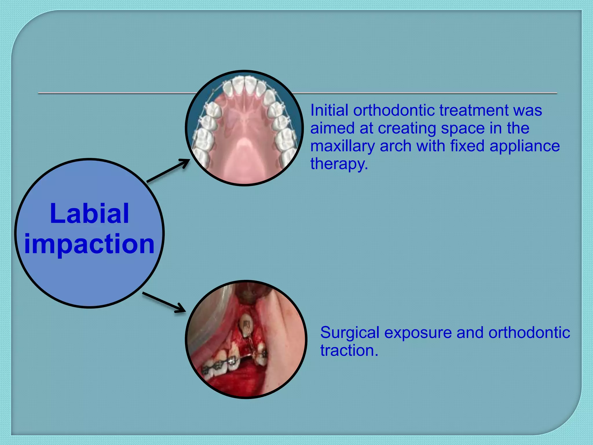 Labial
impaction
Initial orthodontic treatment was
aimed at creating space in the
maxillary arch with fixed appliance
therapy.
Surgical exposure and orthodontic
traction.
 