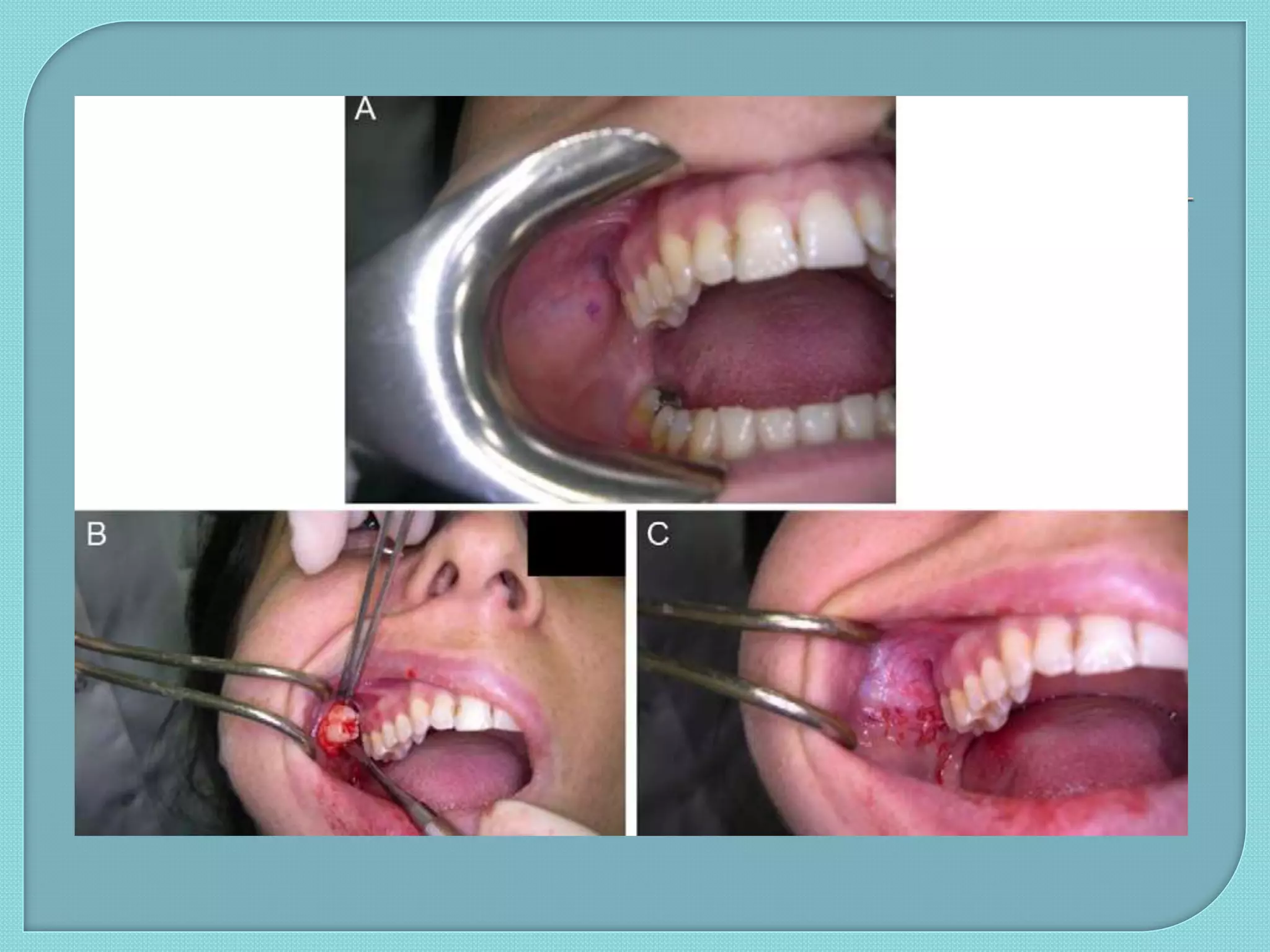 impacted maxillary 3rd molar & canine