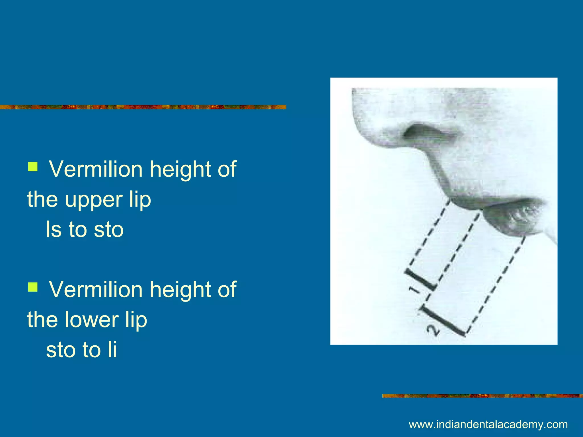  Vermilion height of
the upper lip
ls to sto
 Vermilion height of
the lower lip
sto to li
www.indiandentalacademy.com
 