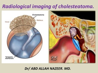 Dr/ ABD ALLAH NAZEER. MD.
Radiological imaging of cholesteatoma.
 