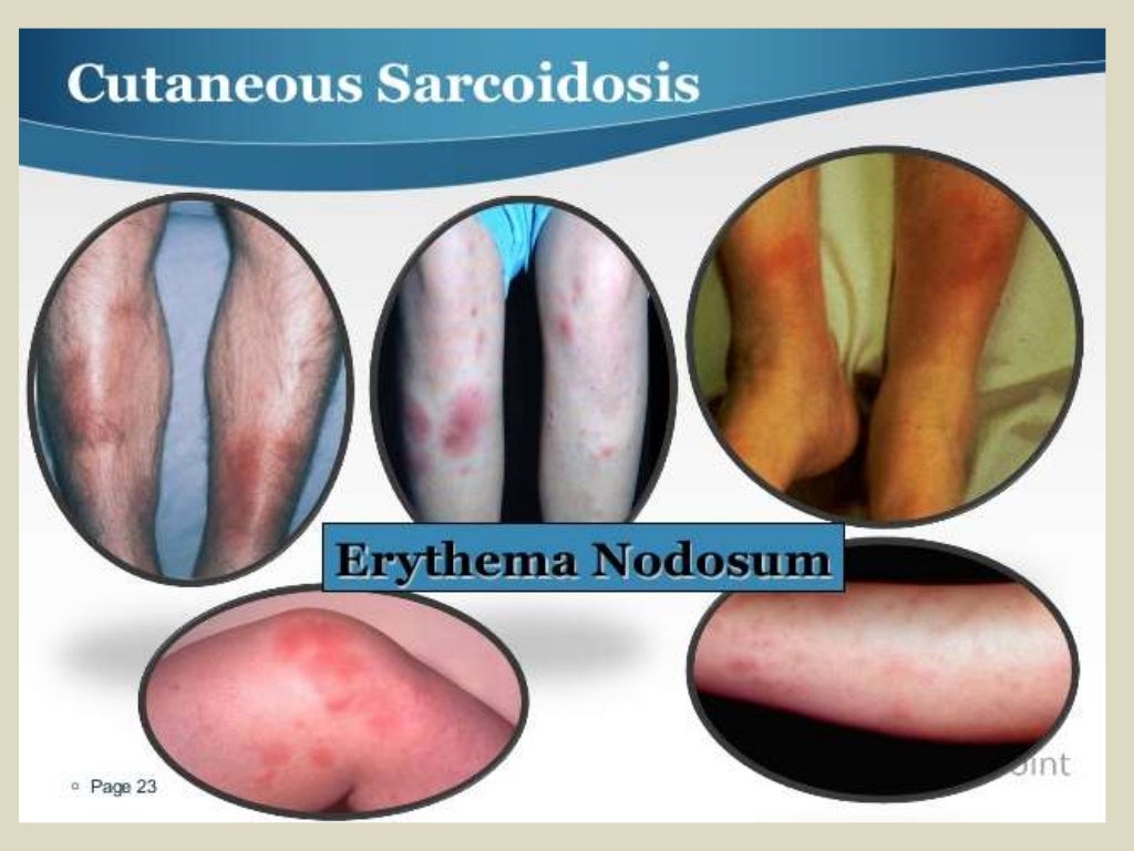 Presentation1.pptx, radiological imaging of sarcoidosis.