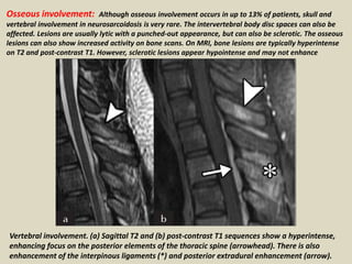 Osseous involvement: Although osseous involvement occurs in up to 13% of patients, skull and
vertebral involvement in neurosarcoidosis is very rare. The intervertebral body disc spaces can also be
affected. Lesions are usually lytic with a punched-out appearance, but can also be sclerotic. The osseous
lesions can also show increased activity on bone scans. On MRI, bone lesions are typically hyperintense
on T2 and post-contrast T1. However, sclerotic lesions appear hypointense and may not enhance
Vertebral involvement. (a) Sagittal T2 and (b) post-contrast T1 sequences show a hyperintense,
enhancing focus on the posterior elements of the thoracic spine (arrowhead). There is also
enhancement of the interpinous ligaments (*) and posterior extradural enhancement (arrow).
 