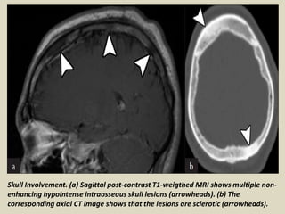 Skull Involvement. (a) Sagittal post-contrast T1-weigthed MRI shows multiple non-
enhancing hypointense intraosseous skull lesions (arrowheads). (b) The
corresponding axial CT image shows that the lesions are sclerotic (arrowheads).
 