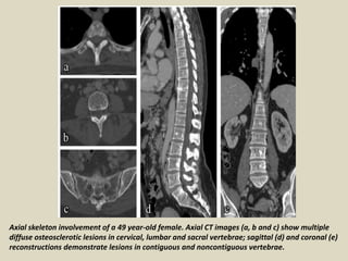 Axial skeleton involvement of a 49 year-old female. Axial CT images (a, b and c) show multiple
diffuse osteosclerotic lesions in cervical, lumbar and sacral vertebrae; sagittal (d) and coronal (e)
reconstructions demonstrate lesions in contiguous and noncontiguous vertebrae.
 