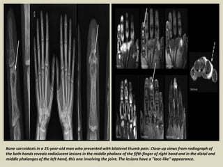 Bone sarcoidosis in a 25-year-old man who presented with bilateral thumb pain. Close-up views from radiograph of
the both hands reveals radiolucent lesions in the middle phalanx of the fifth finger of right hand and in the distal and
middle phalanges of the left hand, this one involving the joint. The lesions have a "lace-like" appearance.
 