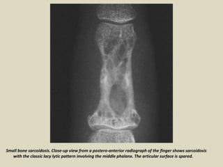Small bone sarcoidosis. Close-up view from a postero-anterior radiograph of the finger shows sarcoidosis
with the classic lacy lytic pattern involving the middle phalanx. The articular surface is spared.
 
