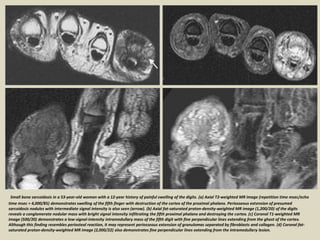 Small bone sarcoidosis in a 53-year-old woman with a 12-year history of painful swelling of the digits. (a) Axial T2-weighted MR image (repetition time msec/echo
time msec = 4,000/85) demonstrates swelling of the fifth finger with destruction of the cortex of the proximal phalanx. Periosseous extension of presumed
sarcoidosis nodules with intermediate signal intensity is also seen (arrow). (b) Axial fat-saturated proton-density-weighted MR image (1,200/20) of the digits
reveals a conglomerate nodular mass with bright signal intensity infiltrating the fifth proximal phalanx and destroying the cortex. (c) Coronal T1-weighted MR
image (500/20) demonstrates a low-signal-intensity intramedullary mass of the fifth digit with fine perpendicular lines extending from the ghost of the cortex.
Although this finding resembles periosteal reaction, it may represent periosseous extension of granulomas separated by fibroblasts and collagen. (d) Coronal fat-
saturated proton-density-weighted MR image (2,000/22) also demonstrates fine perpendicular lines extending from the intramedullary lesion.
 