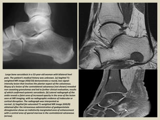 Large bone sarcoidosis in a 53-year-old woman with bilateral heel
pain. The patient’s medical history was unknown. (a) Sagittal T1-
weighted MR image (450/10) demonstrates a round, low-signal-
intensity lesion that involves the plantar aspect of the calcaneous.
Biopsy of a lesion of the contralateral calcaneous (not shown) revealed
non caseating granulomas and led to further clinical evaluation, results
of which confirmed systemic sarcoidosis. (b) Lateral radiograph of the
ankle reveals a faint area of increased opacity in the area of the lesion
seen at MR imaging, with no radiographic evidence of trabecular or
cortical disruption. The radiograph was interpreted as
normal. (c) Sagittal fat-saturated T1-weighted MR image (650/8)
obtained after the intravenous administration of gadopentetate
dimeglumine shows an indistinctly marginated area of enhancement
with a central area of spared marrow in the contralateral calcaneous
(arrow).
 