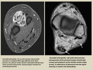 Sarcoidal arthropathy Left ankle demonstrates
tenosynovitis of the peroneal tendon sheath (left
arrow) and tendinosis of the Achilles tendon (right
arrow). A subtle focus of abnormal marrow signal
intensity is noted in the distal fibula.
Sarcoidal arthropathy On an axial contrast-enhanced fat-
saturated T1-weighted MR image (500/10) of the distal
forearm, the extensor tendon sheath is distended with fluid and
shows synovial enhancement. Synovial biopsy revealed non-
caseating granulomas.
 