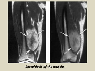 Sarcoidosis of the muscle.
 