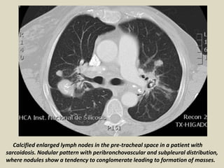 Calcified enlarged lymph nodes in the pre-tracheal space in a patient with
sarcoidosis. Nodular pattern with peribronchovascular and subpleural distribution,
where nodules show a tendency to conglomerate leading to formation of masses.
 
