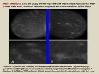 Breast sarcoidosis is rare and usually presents in patients with known sarcoid involving other organ
systems. In the breast, sarcoidosis may mimic malignancy which must be excluded by core biopsy.
Sarcoidosis. 72 years old with skin biopsy and chest radiograph consistent with sarcoidosis. US guided biopsy of a
spiculated mass in the left breast was consistent with sarcoidosis. Fungal and acid fast bacilli stains were negative. A.
(Right) and B. (Left) CC and CC Magnification: Multiple spiculated masses in both breasts, which were stable for 5 years.
 