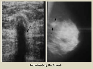 Sarcoidosis of the breast.
 