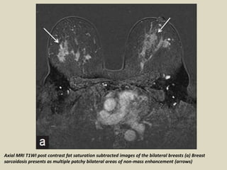 Axial MRI T1WI post contrast fat saturation subtracted images of the bilateral breasts (a) Breast
sarcoidosis presents as multiple patchy bilateral areas of non-mass enhancement (arrows)
 