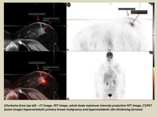 (Clockwise from top left – CT image, PET image, whole body maximum intensity projection PET image, CT/PET
fusion image) Hypermetabolic primary breast malignancy and hypermetabolic skin thickening (arrows)
 