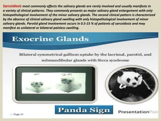 Sarcoidosis most commonly affects the salivary glands are rarely involved and usually manifests in
a variety of clinical patterns. They commonly presents as major salivary gland enlargement with only
histopathological involvement of the minor salivary glands. The second clinical pattern is characterized
by the absence of clinical salivary gland swelling with only histopathological involvement of minor
salivary glands. Parotid gland involvement occurs in 0.5-15 % of patients of sarcoidosis and may
manifest as unilateral or bilateral painless swelling.
 