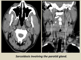 Sarcoidosis involving the parotid gland.
 
