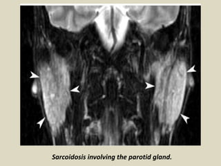 Sarcoidosis involving the parotid gland.
 