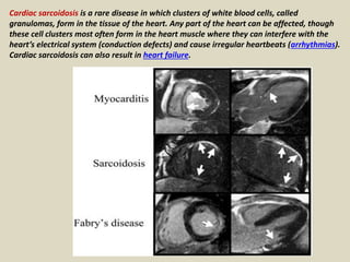 Cardiac sarcoidosis is a rare disease in which clusters of white blood cells, called
granulomas, form in the tissue of the heart. Any part of the heart can be affected, though
these cell clusters most often form in the heart muscle where they can interfere with the
heart’s electrical system (conduction defects) and cause irregular heartbeats (arrhythmias).
Cardiac sarcoidosis can also result in heart failure.
 