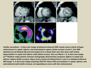 Cardiac sarcoidosis : A short-axis image of delayed-enhanced MRI reveals severe extent of hyper
enhancement in septal, inferior, and anterolateral regions (white arrows). B and C, Cine MRI
obtained at end diastole (B) and end systole (C) in a basal short-axis slice show wall motion
abnormalities in septal and inferior walls (black arrows). Also see Movie I. D, A short-axis image
of 201thallium single photon emission tomography demonstrates perfusion defects in septal and
inferior regions (white arrows), where severe extent of enhancement is seen in a delayed enhanced
MR image. E, A short-axis image of fasting FDG PET shows FDG accumulation in septal, inferior, and
anterolateral walls (white arrows), corresponding to areas with late enhancement.
 