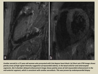 Cardiac sarcoid in a 57-year-old woman who presented with 2nd degree heart block: (a) Short axis STIR image shows
patchy areas of high signal intensity suggestive of myocardial edema, in the basal anterior and anteroseptal
segments. (b) 2-chamber delayed enhancement image shows patchy areas of mid-myocardial enhancement in the
mid-anterior segment, which is consistent with cardiac sarcoidosis. This was proven by endomyocardial biopsy
 