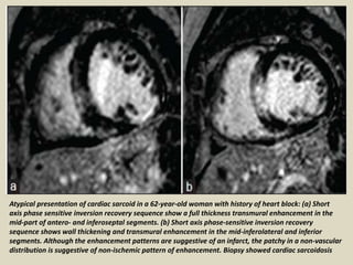 Atypical presentation of cardiac sarcoid in a 62-year-old woman with history of heart block: (a) Short
axis phase sensitive inversion recovery sequence show a full thickness transmural enhancement in the
mid-part of antero- and inferoseptal segments. (b) Short axis phase-sensitive inversion recovery
sequence shows wall thickening and transmural enhancement in the mid-inferolateral and inferior
segments. Although the enhancement patterns are suggestive of an infarct, the patchy in a non-vascular
distribution is suggestive of non-ischemic pattern of enhancement. Biopsy showed cardiac sarcoidosis
 