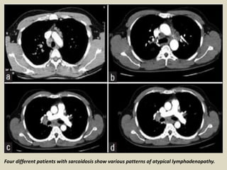 Four different patients with sarcoidosis show various patterns of atypical lymphadenopathy.
 