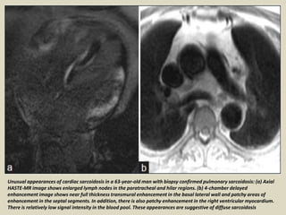 Unusual appearances of cardiac sarcoidosis in a 63-year-old man with biopsy confirmed pulmonary sarcoidosis: (a) Axial
HASTE-MR image shows enlarged lymph nodes in the paratracheal and hilar regions. (b) 4-chamber delayed
enhancement image shows near full thickness transmural enhancement in the basal lateral wall and patchy areas of
enhancement in the septal segments. In addition, there is also patchy enhancement in the right ventricular myocardium.
There is relatively low signal intensity in the blood pool. These appearances are suggestive of diffuse sarcoidosis
 