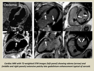 Cardiac MRI with T2-weighted STIR images (left panel) showing edema (arrow) and
(middle and right panels) extensive patchy late gadolinium enhancement typical of sarcoid.
 